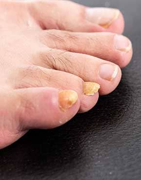 unhealthy toes with fungal toenail infection